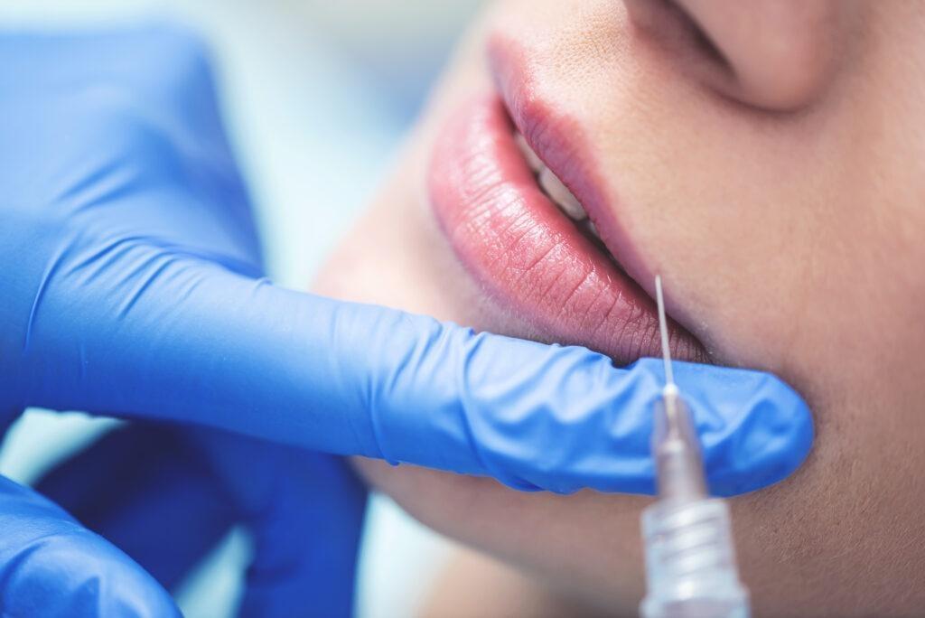 lippen aufspritzen düsseldorf