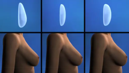 Einführung zur Brust­ver­größerung – Poster