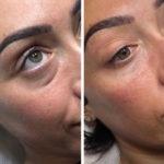 dermatologie augenringe 150x150